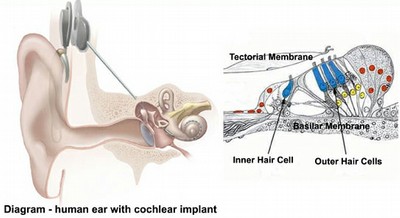 Cochlear Implant