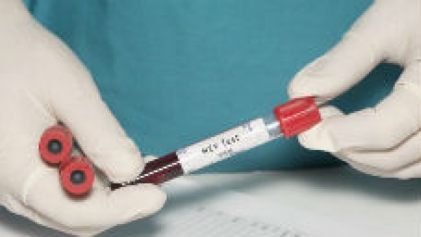HIV vial